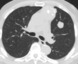 Axial images from an unenhanced chest CT at the level of the pulmonary trunk demonstrate an anterior mediastinal mass with aggressive features suggested by the coarse calcifications within it and the irregular lobulated margin with the lung, suggestive of pulmonary invasion. In addition, there is a pulmonary nodule in the left upper lobe, confirmed by biopsy to represent a metastasis. 